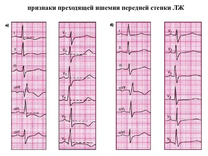 признаки преходящей ишемии передней стенки ЛЖ