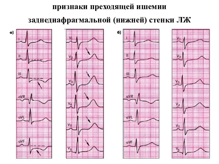 признаки преходящей ишемии заднедиафрагмальной (нижней) стенки ЛЖ