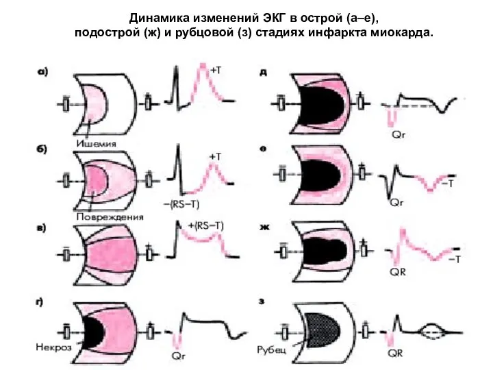 Динамика изменений ЭКГ в острой (а–е), подострой (ж) и рубцовой (з) стадиях инфаркта миокарда.