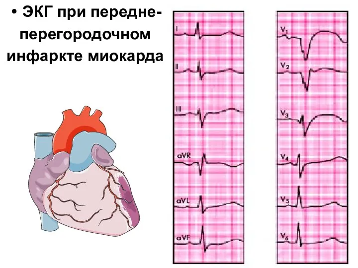 ЭКГ при передне- перегородочном инфаркте миокарда