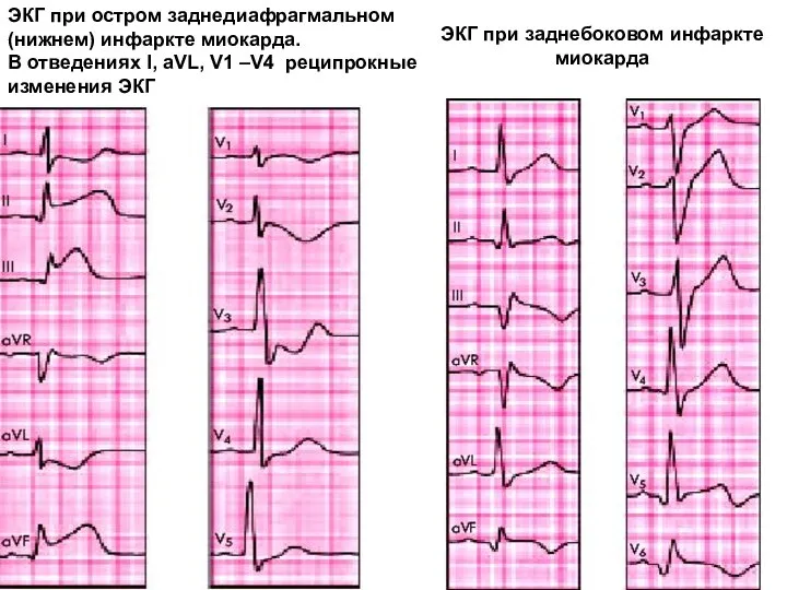 ЭКГ при заднебоковом инфаркте миокарда ЭКГ при остром заднедиафрагмальном (нижнем) инфаркте