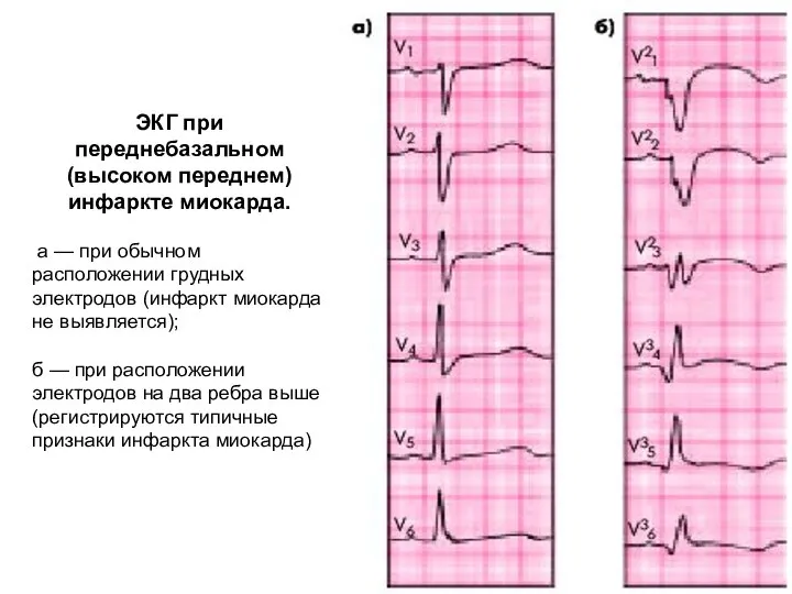 ЭКГ при переднебазальном (высоком переднем) инфаркте миокарда. а — при обычном