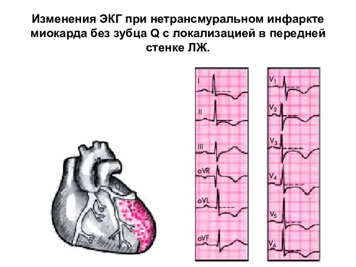 Изменения ЭКГ при нетрансмуральном инфаркте миокарда без зубца Q с локализацией в передней стенке ЛЖ.