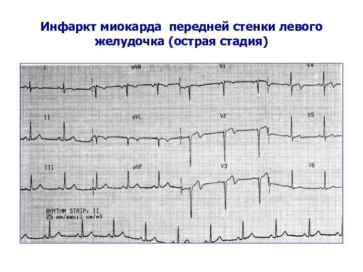 Инфаркт миокарда передней стенки левого желудочка (острая стадия)