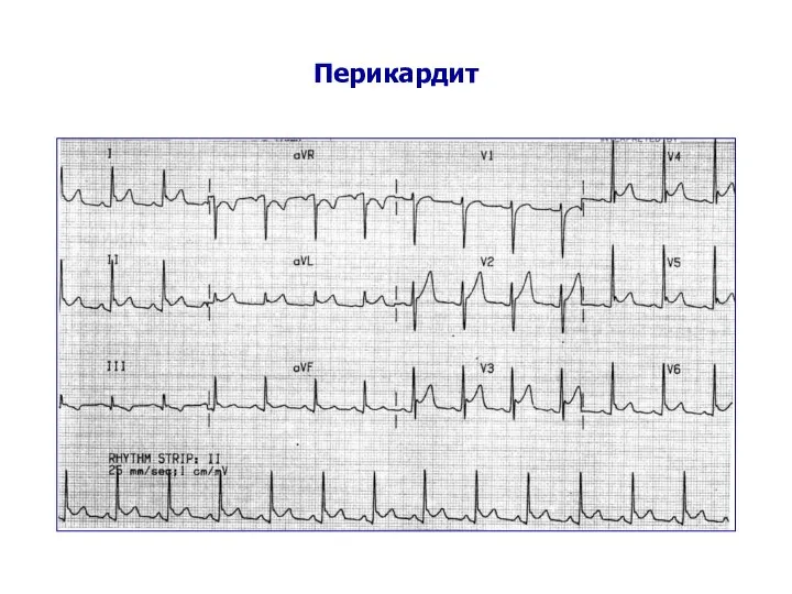 Перикардит