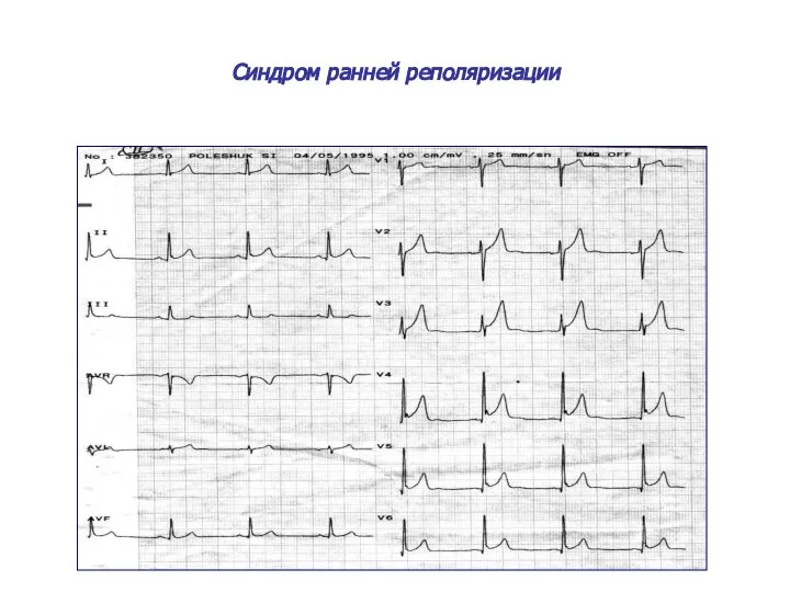 Синдром ранней реполяризации