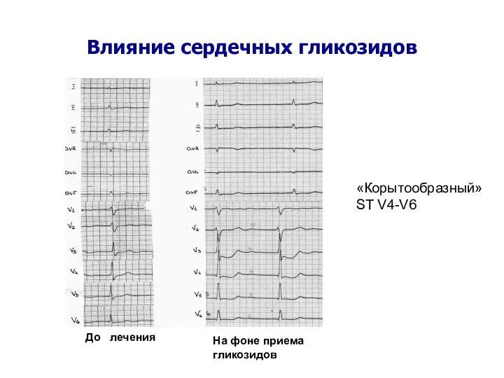 Влияние сердечных гликозидов «Корытообразный» ST V4-V6 До лечения На фоне приема гликозидов