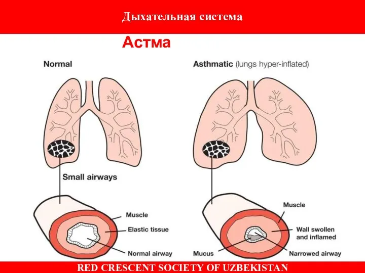 Астма Дыхательная система