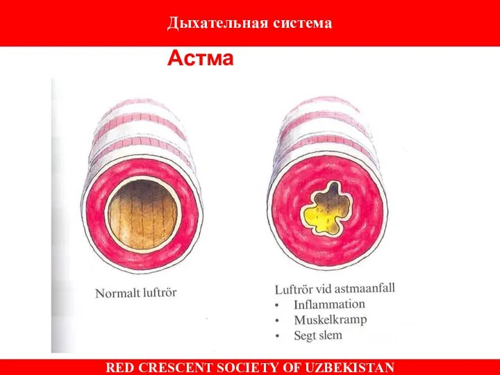 Астма Дыхательная система