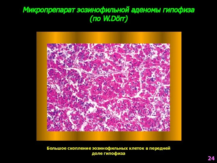 Микропрепарат эозинофильной аденомы гипофиза (по W.Dörr) Большое скопление эозинофильных клеток в передней доле гипофиза 24