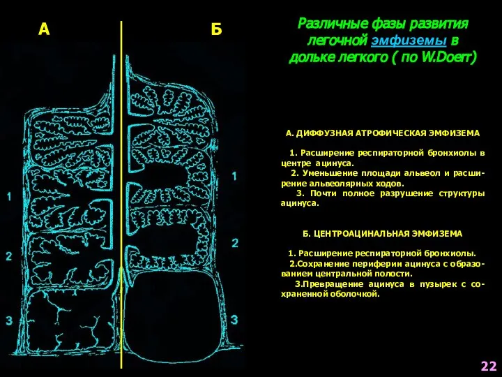 Различные фазы развития легочной эмфиземы в дольке легкого ( по W.Doerr)