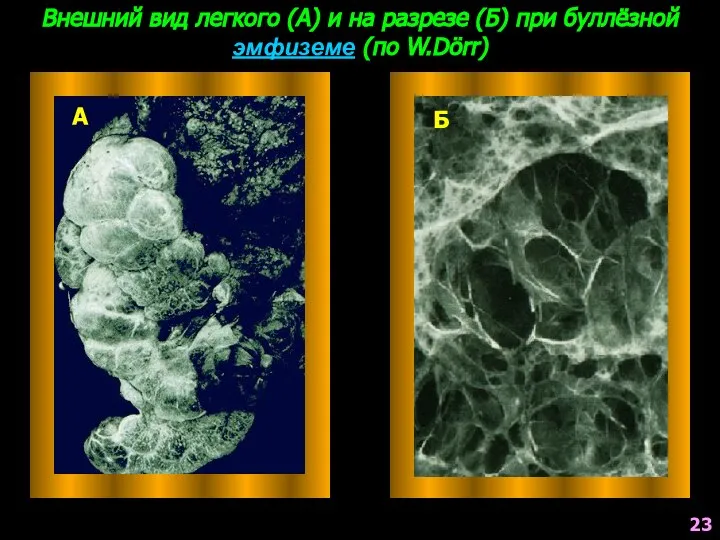 Внешний вид легкого (А) и на разрезе (Б) при буллёзной эмфиземе (по W.Dörr) А Б 23