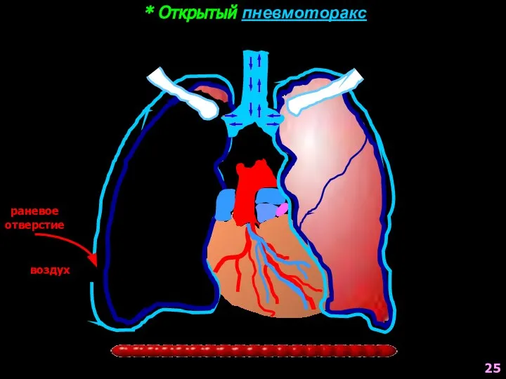 * Открытый пневмоторакс раневое отверстие воздух воздух 25