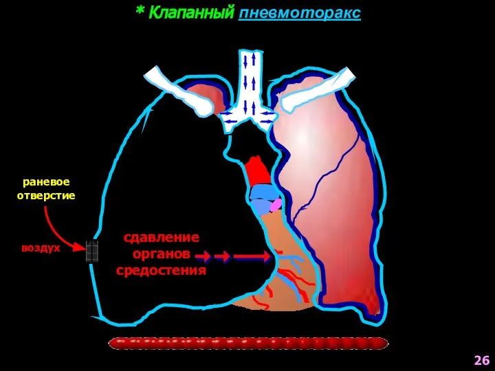 * Клапанный пневмоторакс раневое отверстие воздух сдавление органов средостения 26