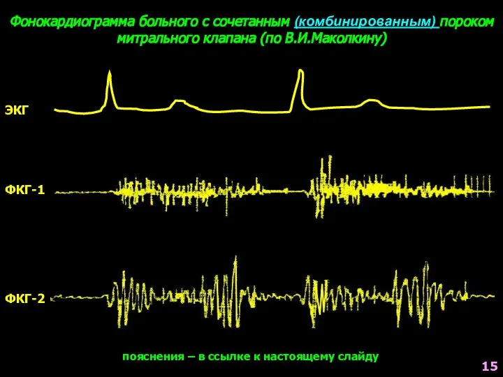 Фонокардиограмма больного с сочетанным (комбинированным) пороком митрального клапана (по В.И.Маколкину) ЭКГ