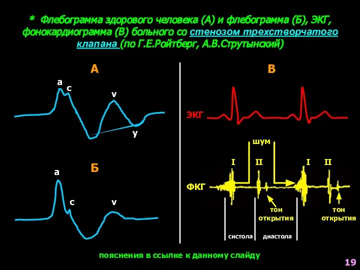 * Флебограмма здорового человека (А) и флебограмма (Б), ЭКГ, фонокардиограмма (В)