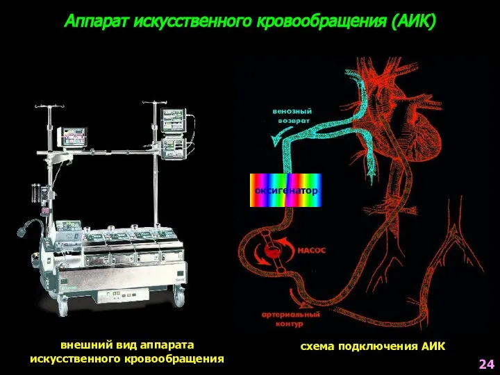 Аппарат искусственного кровообращения (АИК) 24 внешний вид аппарата искусственного кровообращения оксигенатор схема подключения АИК