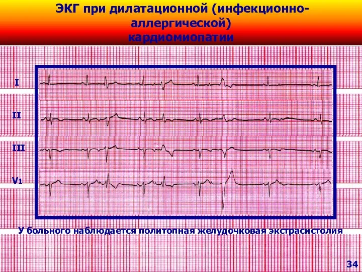 I II III V1 ЭКГ при дилатационной (инфекционно-аллергической) кардиомиопатии 34 У больного наблюдается политопная желудочковая экстрасистолия