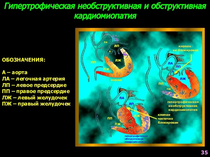 Гипертрофическая необструктивная и обструктивная кардиомиопатия ОБОЗНАЧЕНИЯ: А – аорта ЛА –