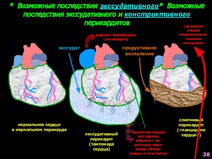 * Возможные последствия экссудативного* Возможные последствия экссудативного и констриктивного перикардитов нормальное