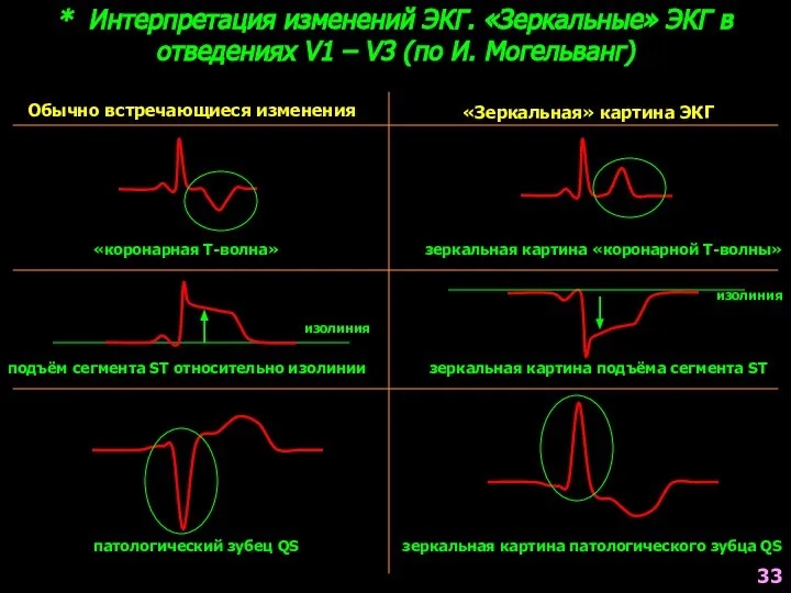 * Интерпретация изменений ЭКГ. «Зеркальные» ЭКГ в отведениях V1 – V3