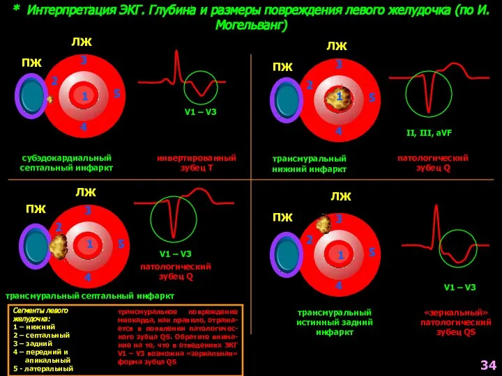 * Интерпретация ЭКГ. Глубина и размеры повреждения левого желудочка (по И.