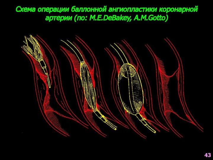 Схема операции баллонной ангиопластики коронарной артерии (по: M.E.DeBakey, A.M.Gotto) 43