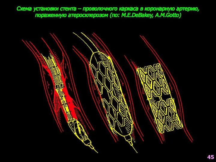 Схема установки стента – проволочного каркаса в коронарную артерию, пораженную атеросклерозом (по: M.E.DeBakey, A.M.Gotto) 45