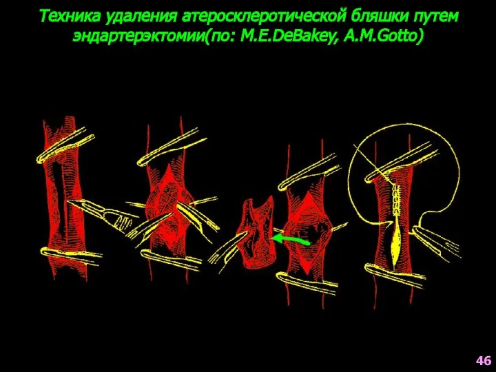 Техника удаления атеросклеротической бляшки путем эндартерэктомии(по: M.E.DeBakey, A.M.Gotto) 46