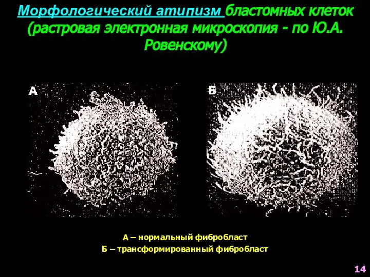 Морфологический атипизм бластомных клеток (растровая электронная микроскопия - по Ю.А.Ровенскому) А