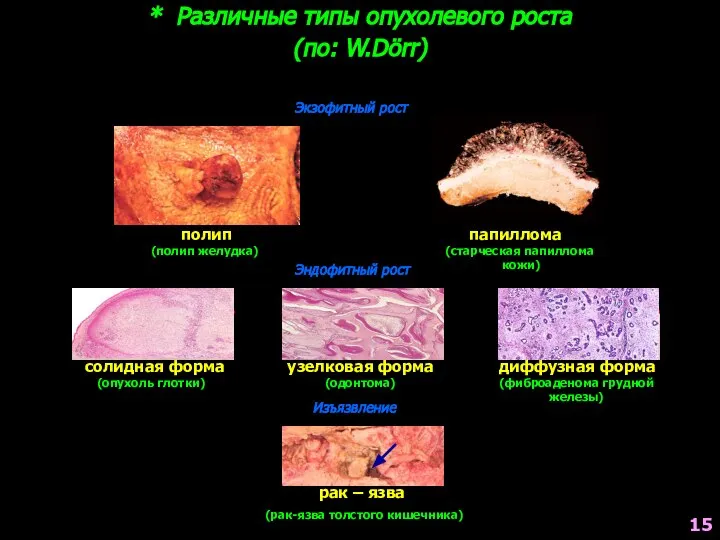 * Различные типы опухолевого роста (по: W.Böcker, H.Denk, Ph.U.Heitz) Экзофитный рост