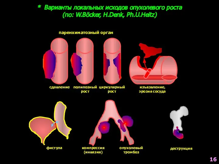 * Варианты локальных исходов опухолевого роста (по: W.Böcker, H.Denk, Ph.U.Heitz) сдавление