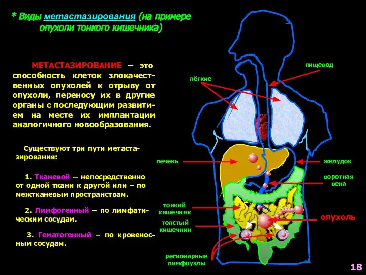 * Виды метастазирования (на примере опухоли тонкого кишечника) пищевод желудок печень