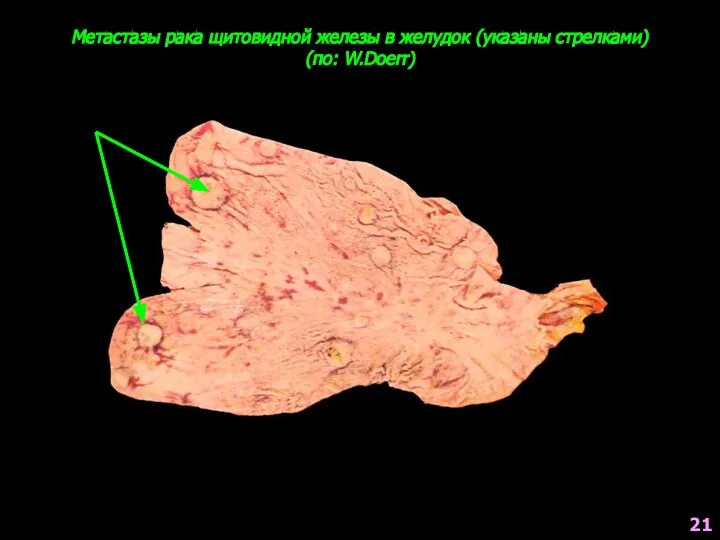 Метастазы рака щитовидной железы в желудок (указаны стрелками) (по: W.Doerr) 21