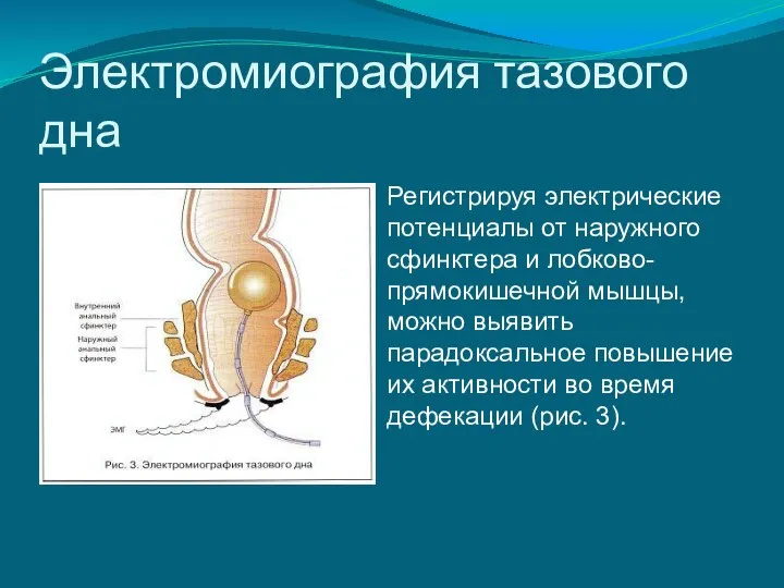 Электромиография тазового дна Регистрируя электрические потенциалы от наружного сфинктера и лобково-прямокишечной