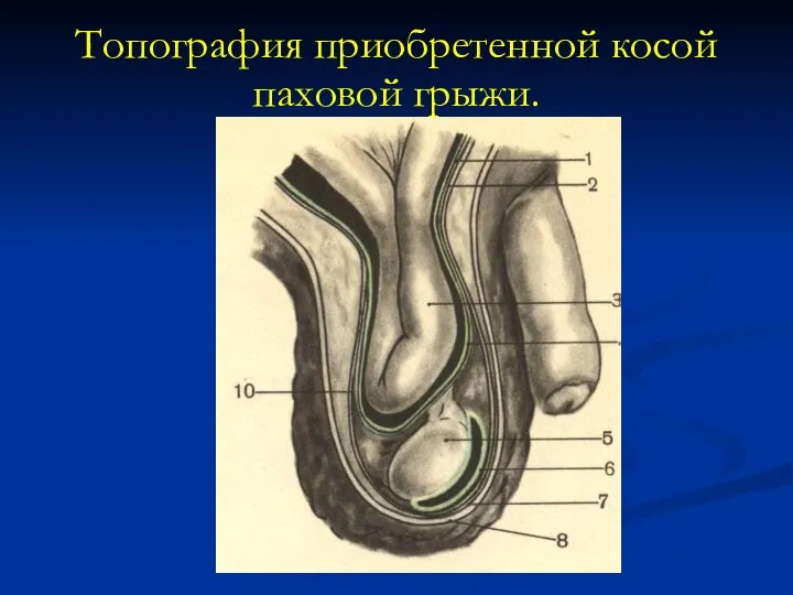 Топография приобретенной косой паховой грыжи.