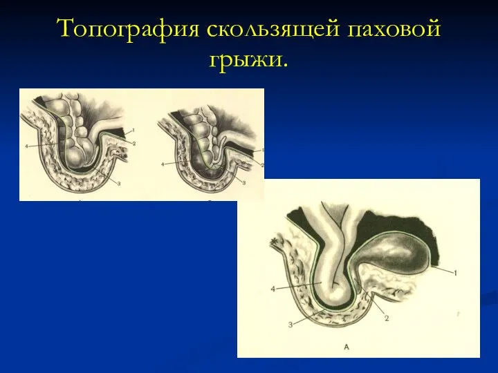 Топография скользящей паховой грыжи.