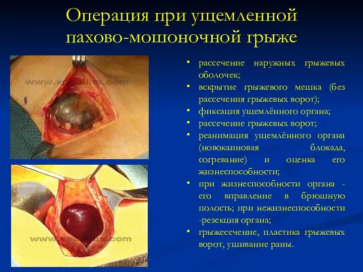 Операция при ущемленной пахово-мошоночной грыже рассечение наружных грыжевых оболочек; вскрытие грыжевого