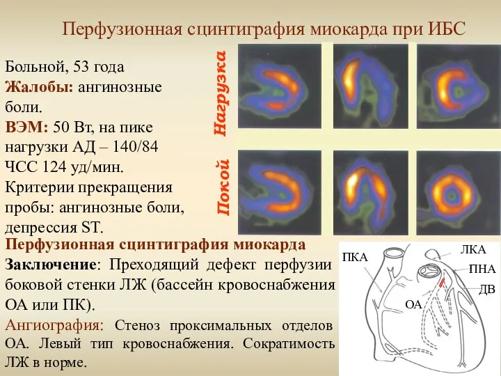 Нагрузка Покой Перфузионная сцинтиграфия миокарда при ИБС Больной, 53 года Жалобы: