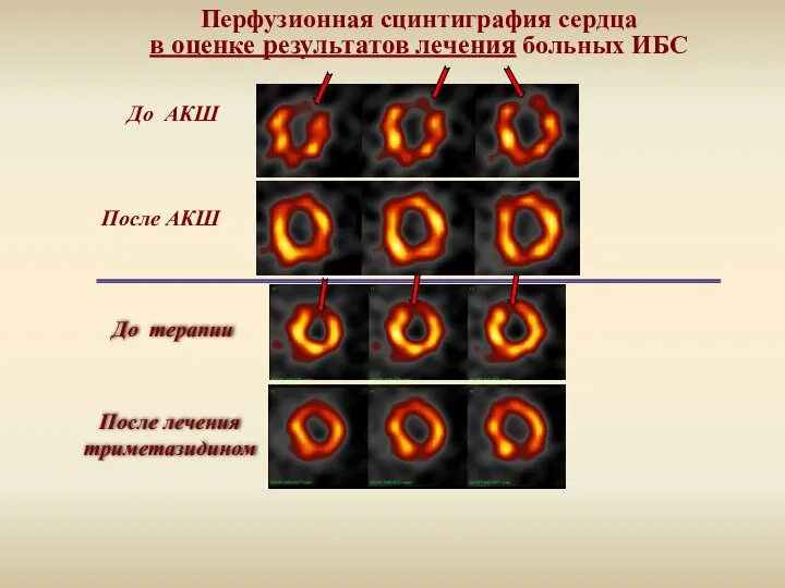 Перфузионная сцинтиграфия сердца в оценке результатов лечения больных ИБС До АКШ