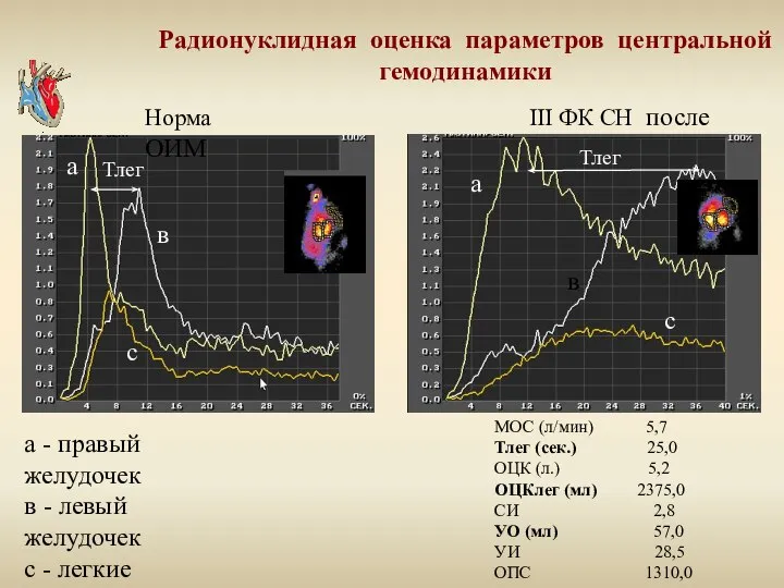 Радионуклидная оценка параметров центральной гемодинамики Тлег а в в с с