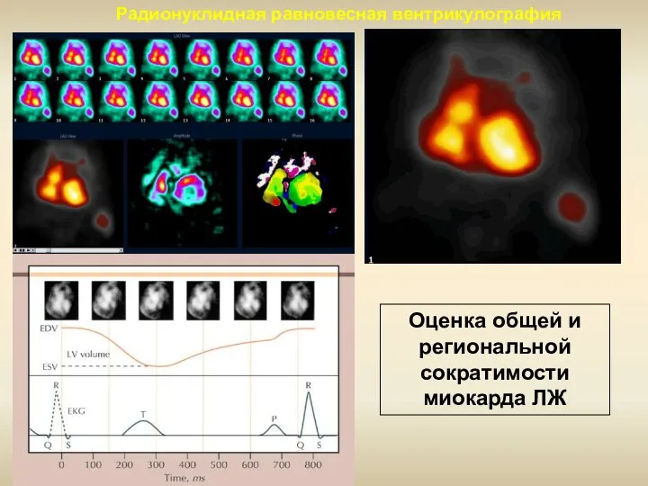 Радионуклидная равновесная вентрикулография Оценка общей и региональной сократимости миокарда ЛЖ