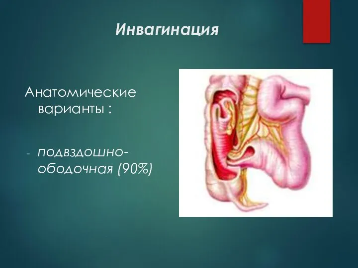 Инвагинация Анатомические варианты : подвздошно-ободочная (90%)