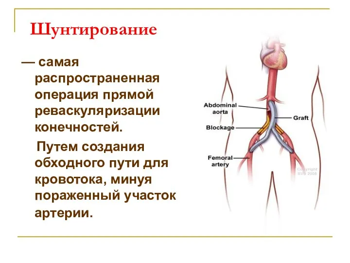 Шунтирование — самая распространенная операция прямой реваскуляризации конечностей. Путем создания обходного