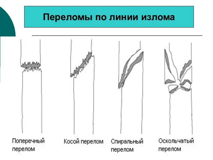 Переломы по линии излома