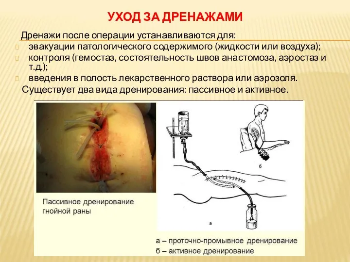 УХОД ЗА ДРЕНАЖАМИ Дренажи после операции устанавливаются для: эвакуации патологического содержимого