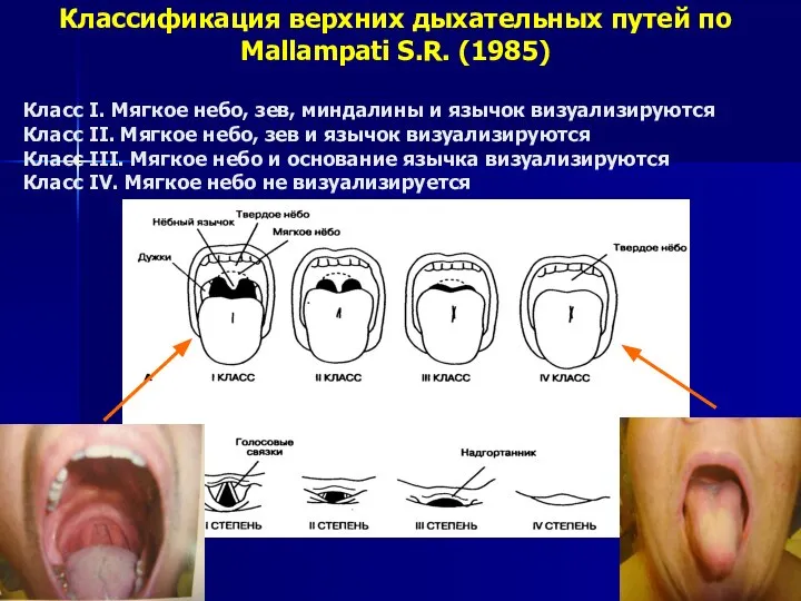 Классификация верхних дыхательных путей по Mallampati S.R. (1985) Класс I. Мягкое