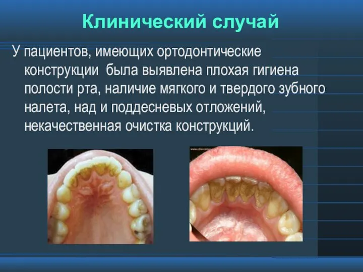 Клинический случай У пациентов, имеющих ортодонтические конструкции была выявлена плохая гигиена