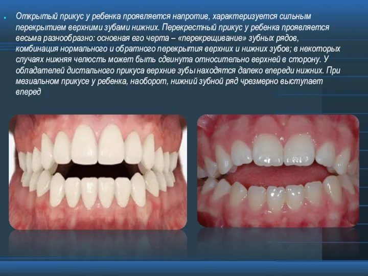 Открытый прикус у ребенка проявляется напротив, характеризуется сильным перекрытием верхними зубами
