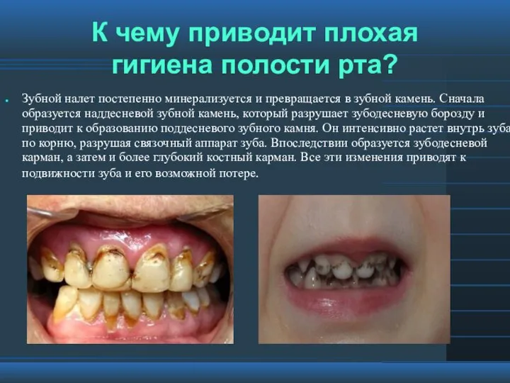 К чему приводит плохая гигиена полости рта? Зубной налет постепенно минерализуется